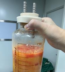 泗阳水动力吸脂手术要做多久？